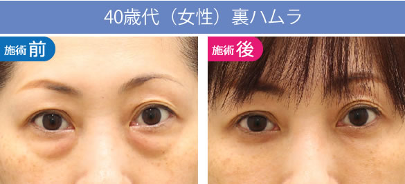 目の下のくま・たるみ治療「裏ハムラ」の40歳代の症例
