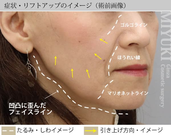 症状・リフトアップのイメージ（術前画像）
