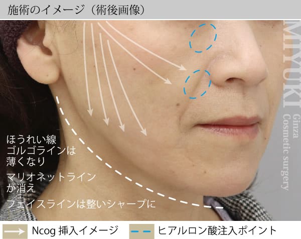 施術のイメージ（術後画像）