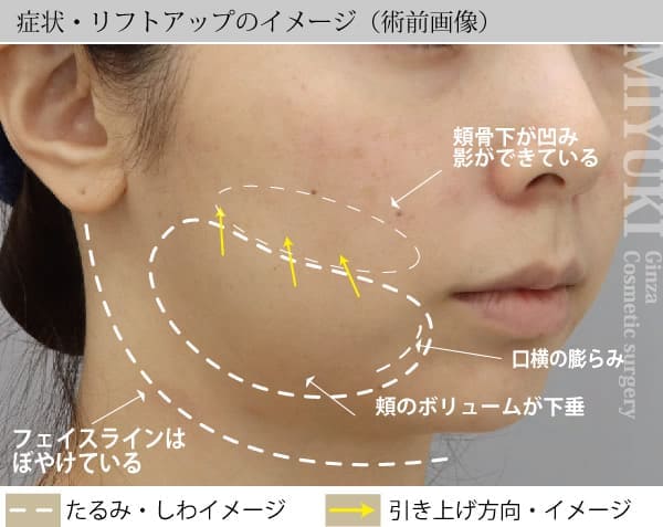 症状・リフトアップのイメージ（術前画像）