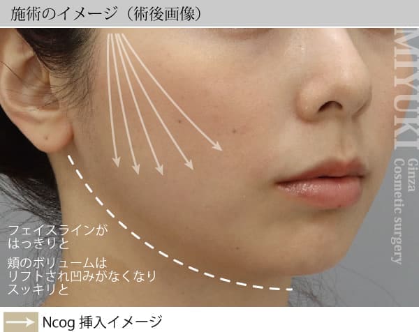 施術のイメージ（術後画像）