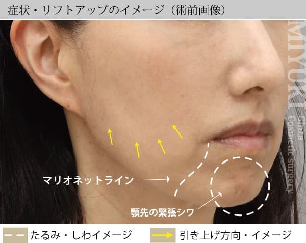 症状・リフトアップのイメージ（術前画像）