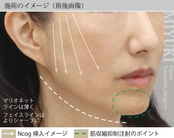 施術のイメージ（術後画像）
