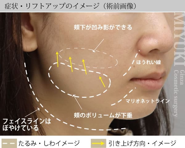 症状・リフトアップのイメージ（術前画像）