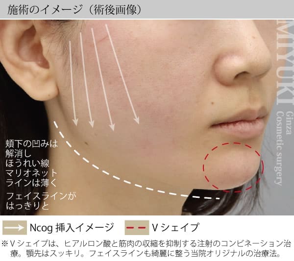 施術のイメージ（術後画像）