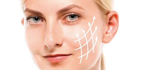 糸リフト「Nコグ」糸の挿入イメージ