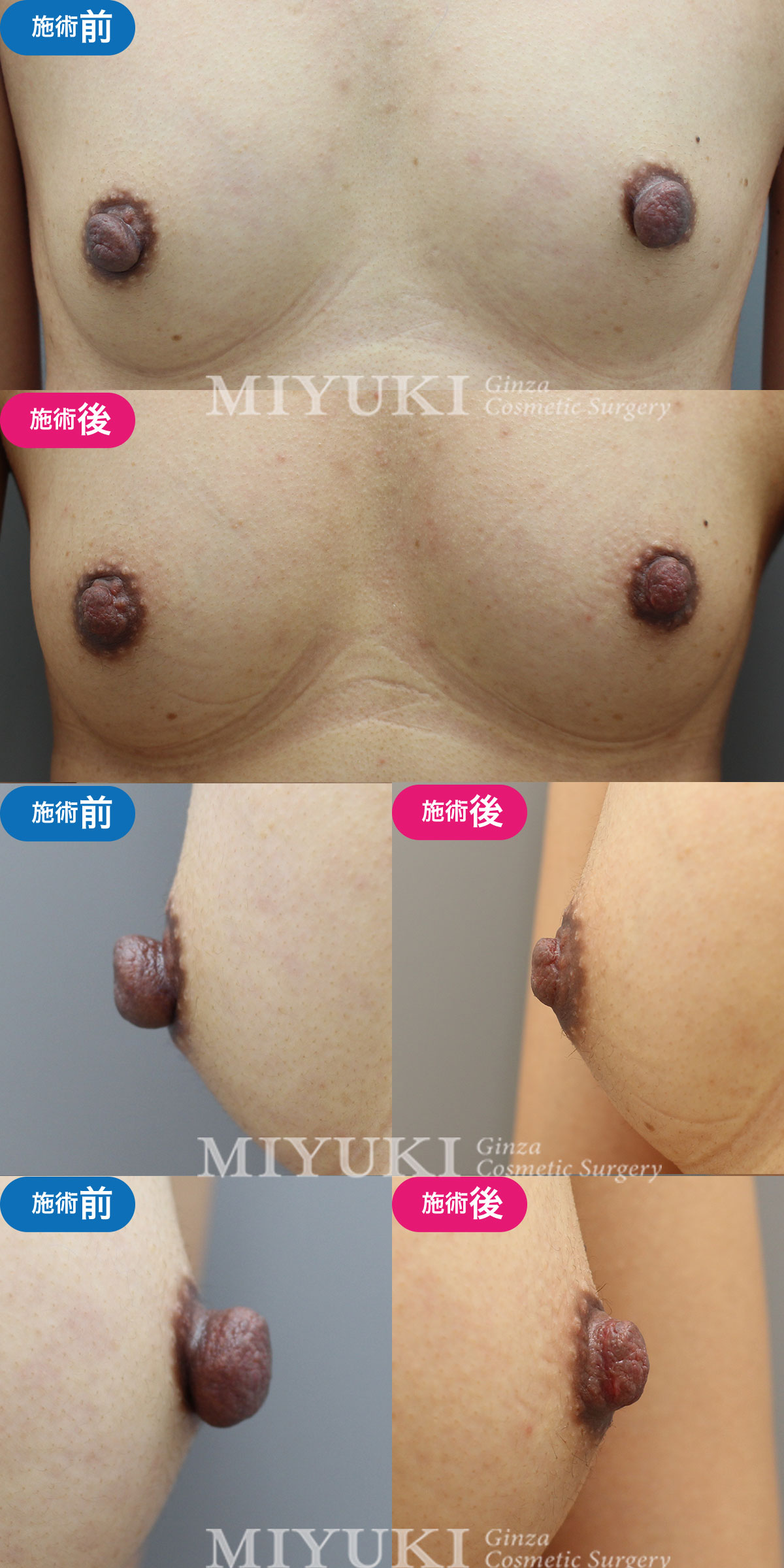 モニター№006乳頭縮小の症例画像