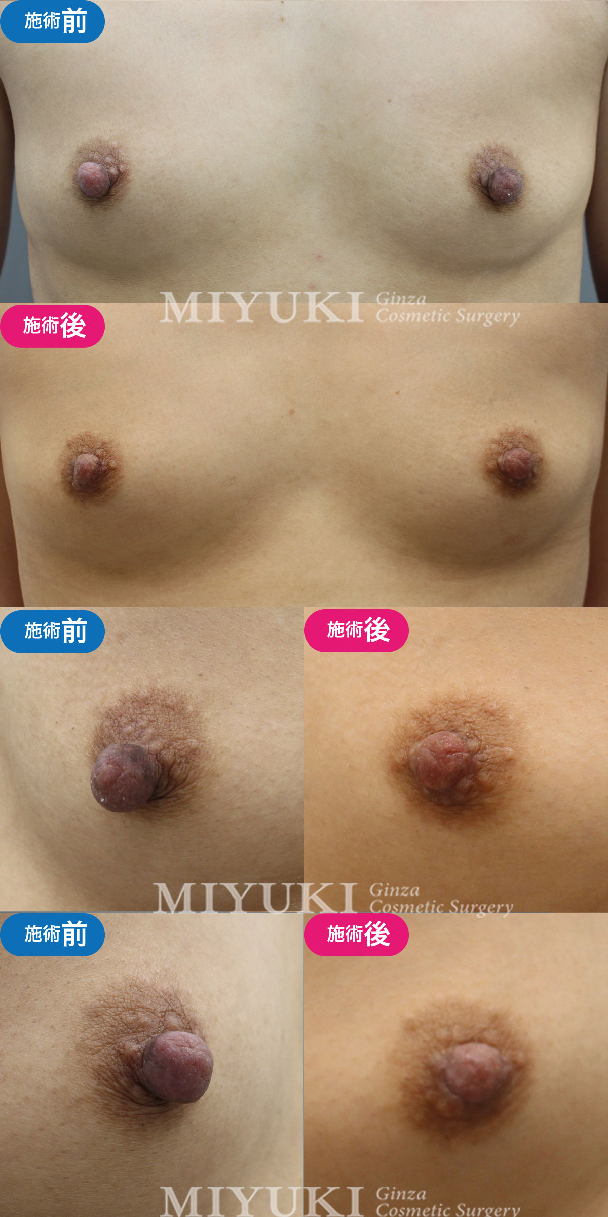 モニター№007乳頭縮小の症例画像