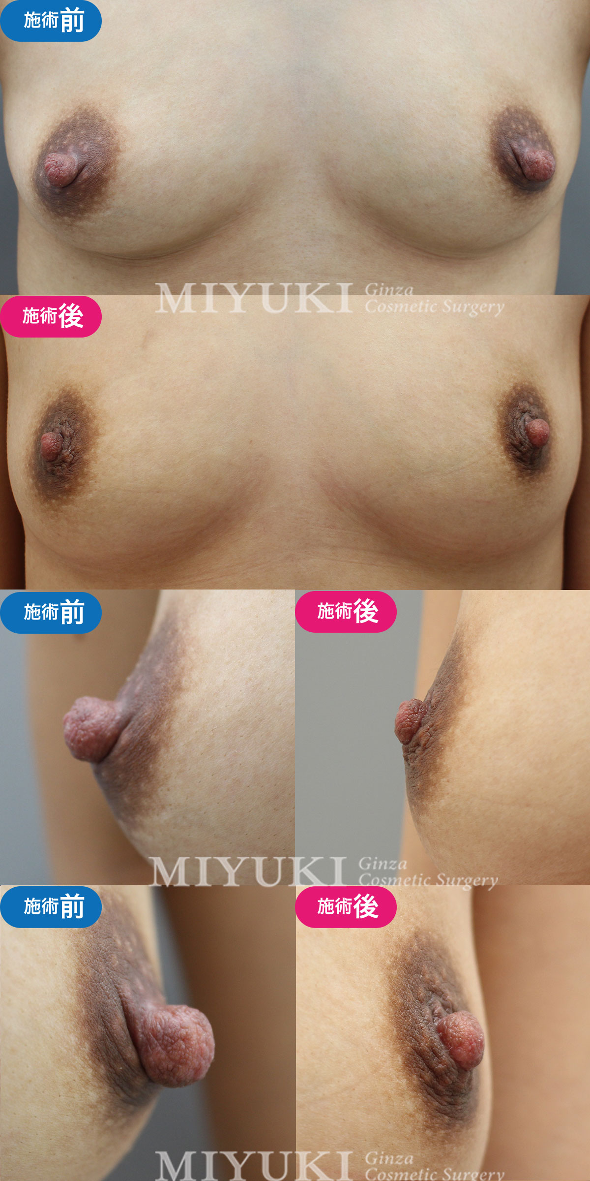 モニター№008乳頭縮小の症例画像