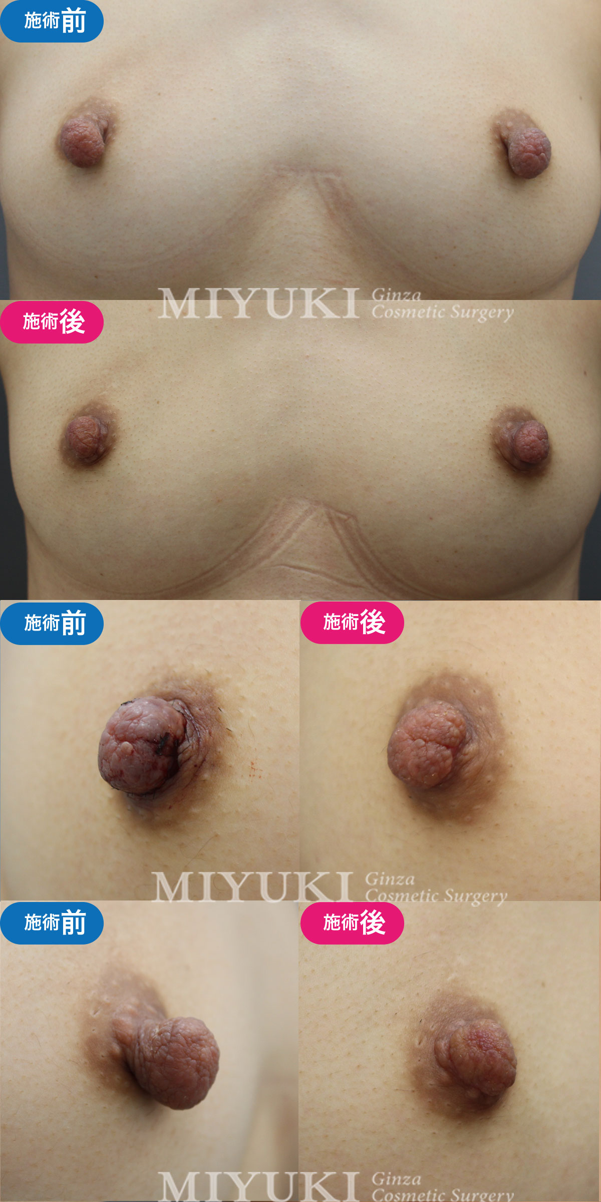 モニター№010乳頭縮小の症例画像