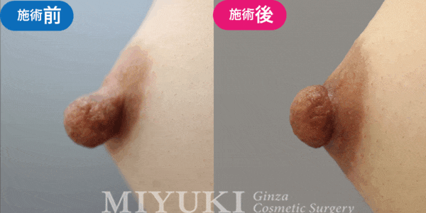 乳頭形成モニター症例№002（20代 ）