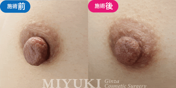 乳頭形成モニター症例№003（20代 ）