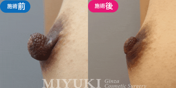 乳頭形成モニター症例№004（30代 ）