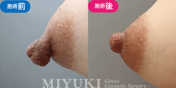 乳頭形成モニター症例№005（50代 ）