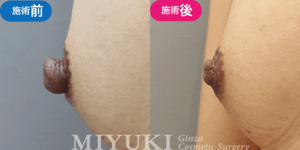 乳頭形成モニター症例№006（30代 ）