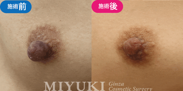 乳頭形成モニター症例№007（30代 ）
