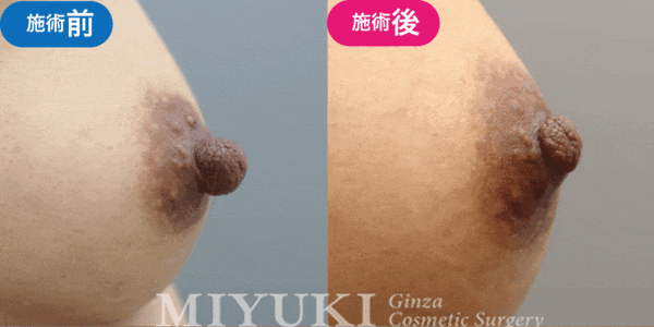 乳頭形成モニター症例№009（30代 ）