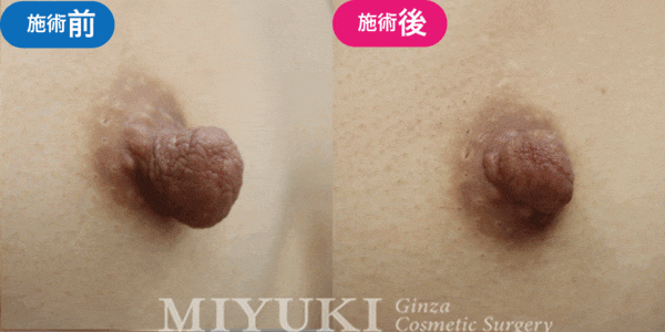 乳頭形成モニター症例№010（30代 ）