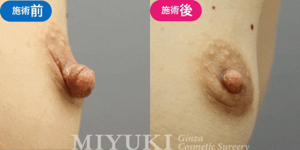 乳頭形成モニター症例№011（40代 ）