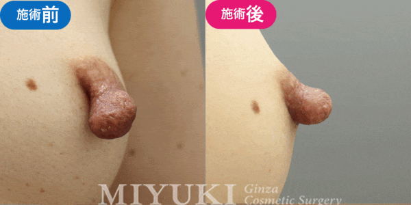 乳頭形成モニター症例№012（40代 ）