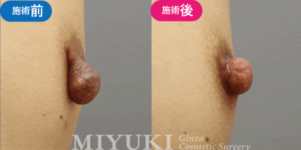 乳頭形成モニター症例№015（30代 ）