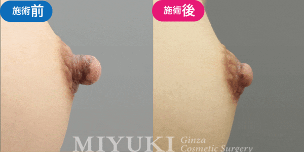乳頭形成モニター症例№016（30代 ）