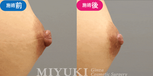 乳頭形成モニター症例№017（30代 ）