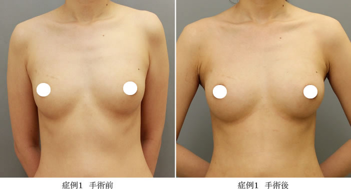 コンデンスリッチ豊胸症例01-1