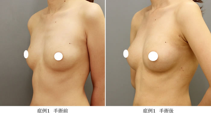 コンデンスリッチ豊胸症例01-2