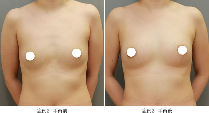 コンデンスリッチ豊胸症例02-1