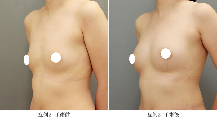 コンデンスリッチ豊胸症例02-2