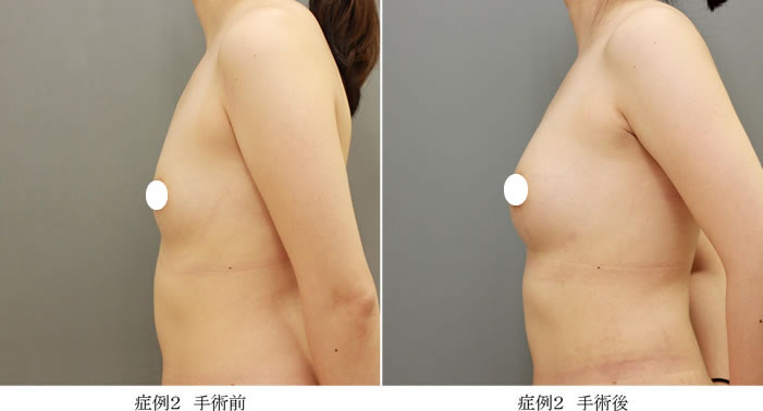 コンデンスリッチ豊胸症例02-2