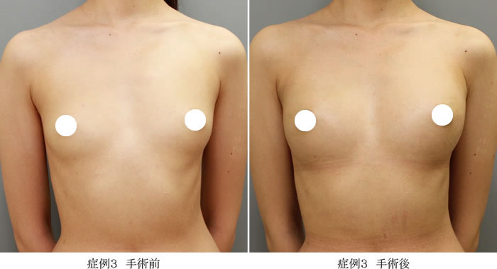 コンデンスリッチ豊胸症例03-1