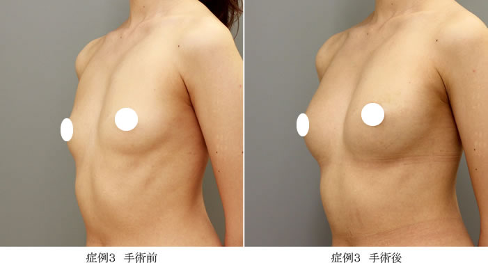 コンデンスリッチ豊胸症例03-2