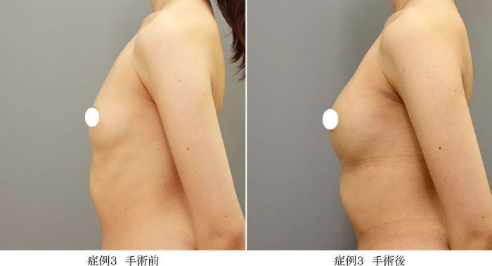 コンデンスリッチ豊胸症例03-2