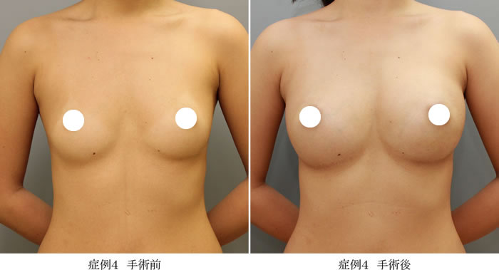 コンデンスリッチ豊胸症例04-1