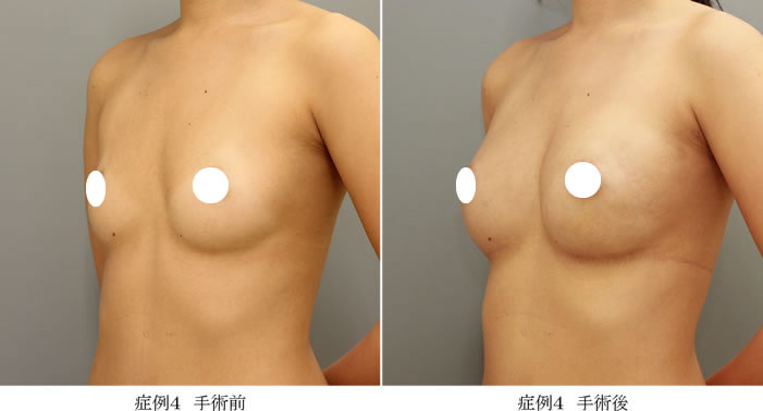 コンデンスリッチ豊胸症例04-2