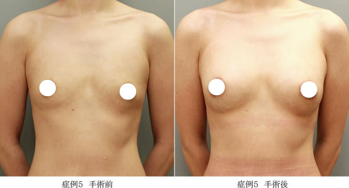 コンデンスリッチ豊胸症例05-1