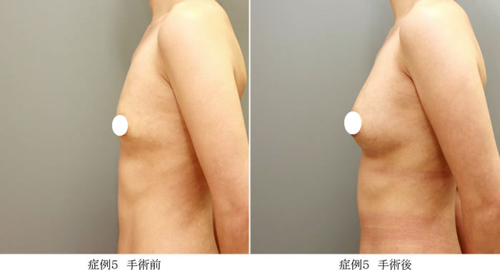 コンデンスリッチ豊胸症例05-2