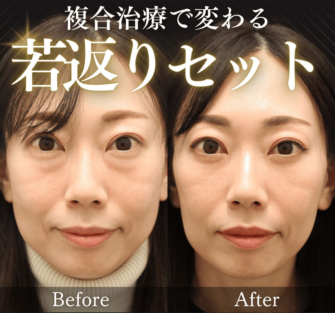 みゆき若返りセット(クマ取り治療 + 糸リフト)のイメージ画像