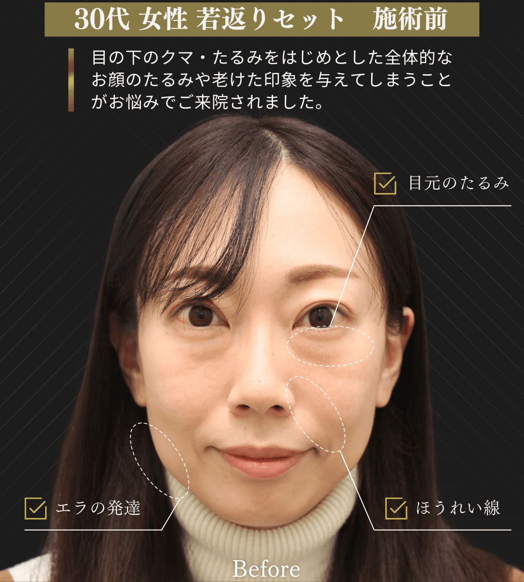 みゆき若返りセット(クマ取り治療 + 糸リフト)のイメージ画像2