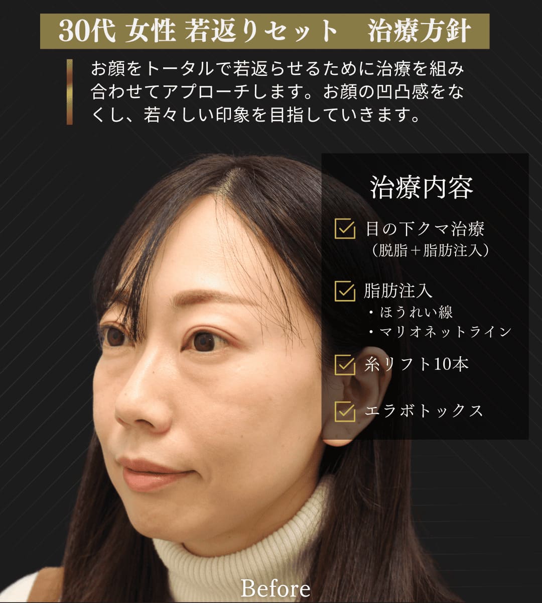 みゆき若返りセット(クマ取り治療 + 糸リフト)のイメージ画像3