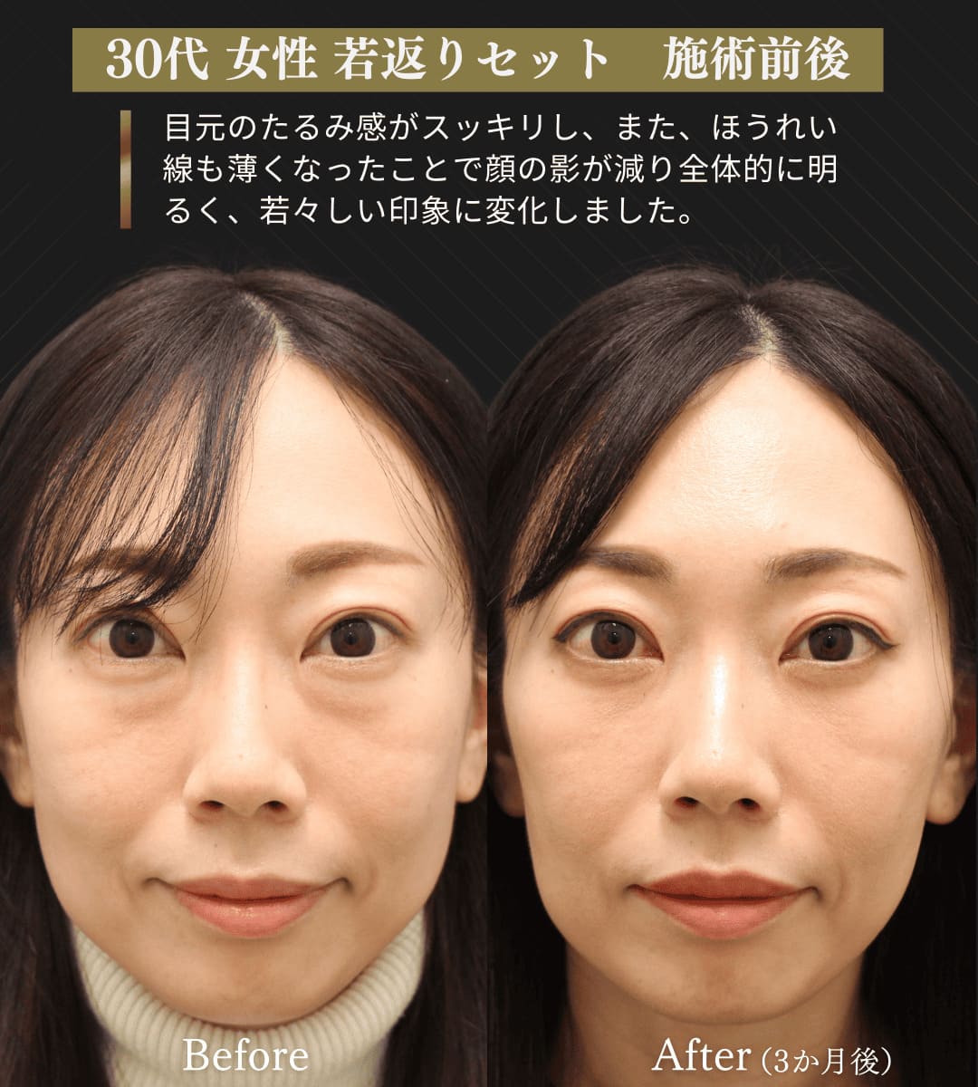 みゆき若返りセット(クマ取り治療 + 糸リフト)のイメージ画像4