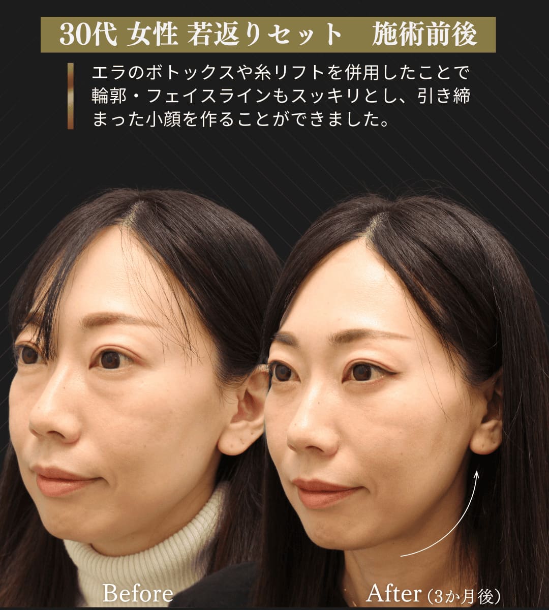 みゆき若返りセット(クマ取り治療 + 糸リフト)のイメージ画像5