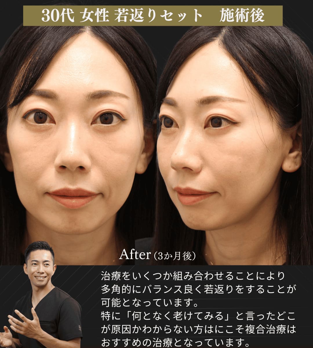 みゆき若返りセット(クマ取り治療 + 糸リフト)のイメージ画像6