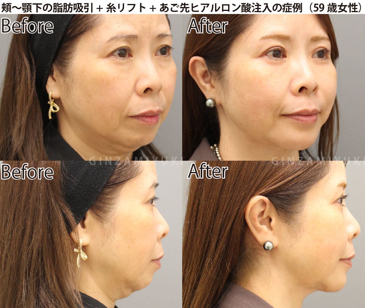 二重顎・輪郭の糸リフト症例