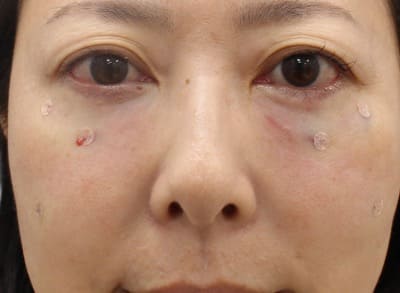 脱脂＋脂肪注入のダウンタイム手術直後
