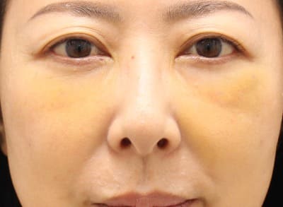 脱脂＋脂肪注入のダウンタイム術後3日-1