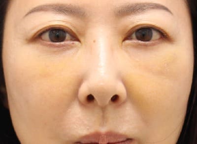 脱脂＋脂肪注入のダウンタイム術後3日-2