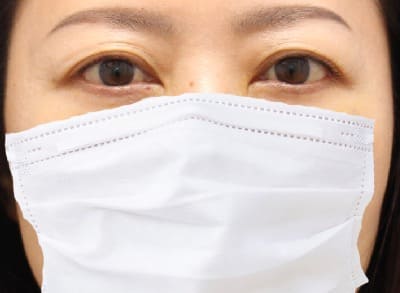 脱脂＋脂肪注入のダウンタイム術後3日-3